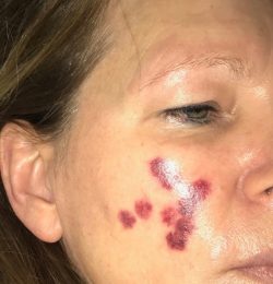 Na de eerste IPL behandeling