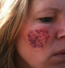 Na de eerste Vaatlaser behandeling