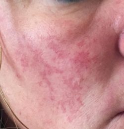 Resultaat eerste Vaatlaser behandeling …. Het is zelfs erger dan begin stadium