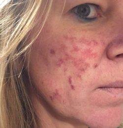 Na de IPL behandelingen… uiteindelijk gestopt omdat Herpes wederom terug kwam en het vertrouwen weg was in de medische behandeling..