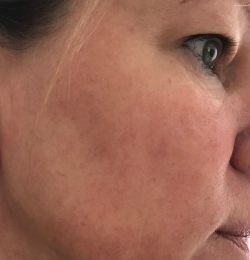 Na 4 weken environ…Is de huid mooier dan hij ooit was…